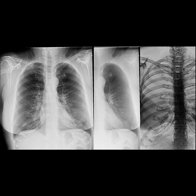 Dual-Energy-image-round-gradient