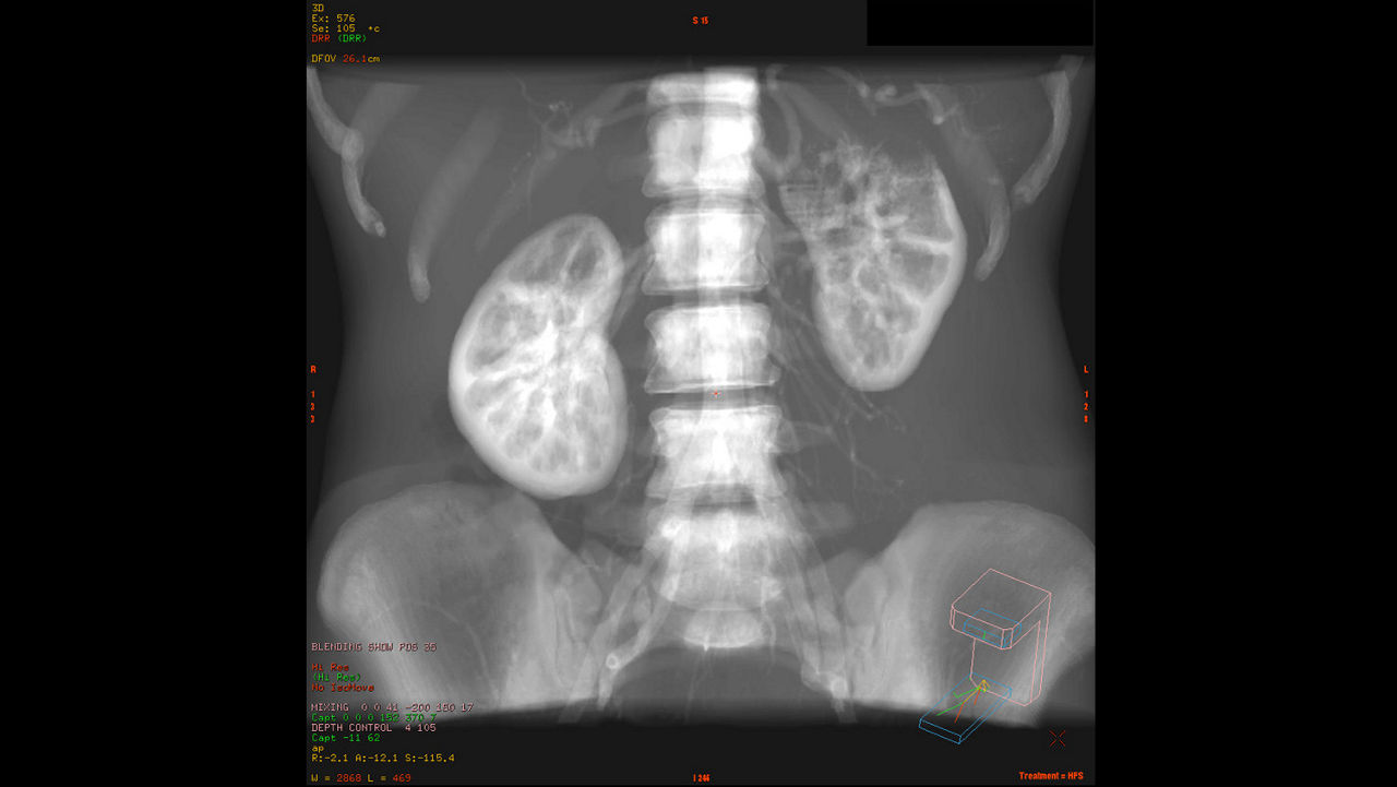 dvanced-visualization-applications-advantagesim-md-aw-advantagesim-md-clinical-image-1