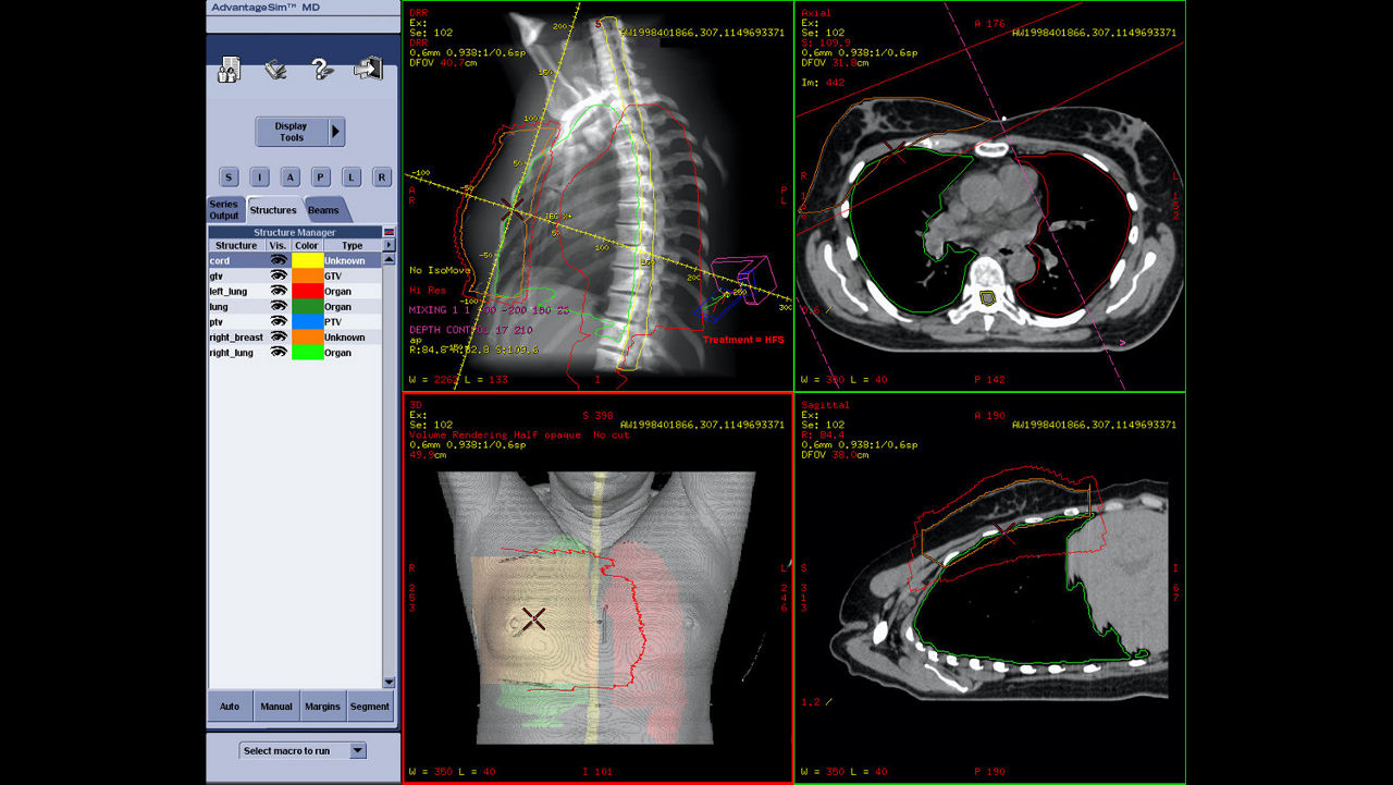 dvanced-visualization-applications-advantagesim-md-aw-advantagesim-md-clinical-image-2