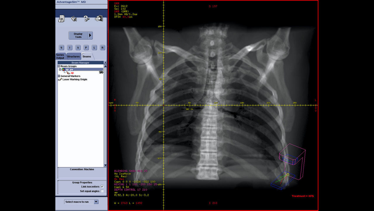 dvanced-visualization-applications-advantagesim-md-aw-advantagesim-md-clinical-image-3