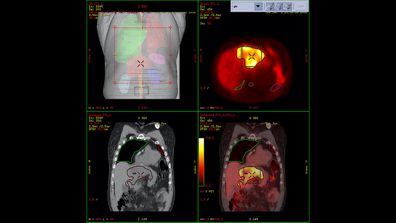 dvanced-visualization-applications-advantagesim-md-aw-advantagesim-md-clinical-image-4