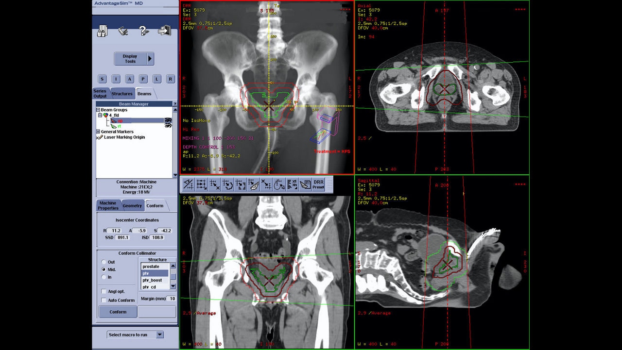 dvanced-visualization-applications-advantagesim-md-aw-advantagesim-md-clinical-image-5
