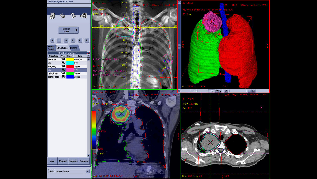 dvanced-visualization-applications-advantagesim-md-aw-advantagesim-md-clinical-image-6