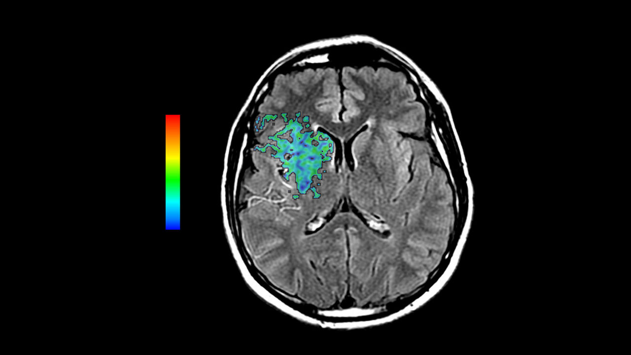 dvanced-visualization-applications-readyview-aw-readyview-clinical-image-brain-stroke