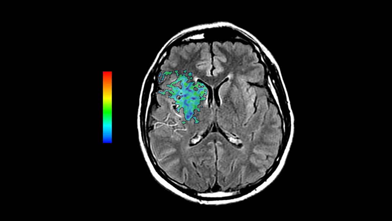 dvanced-visualization-applications-readyview-aw-readyview-clinical-image-brain-stroke