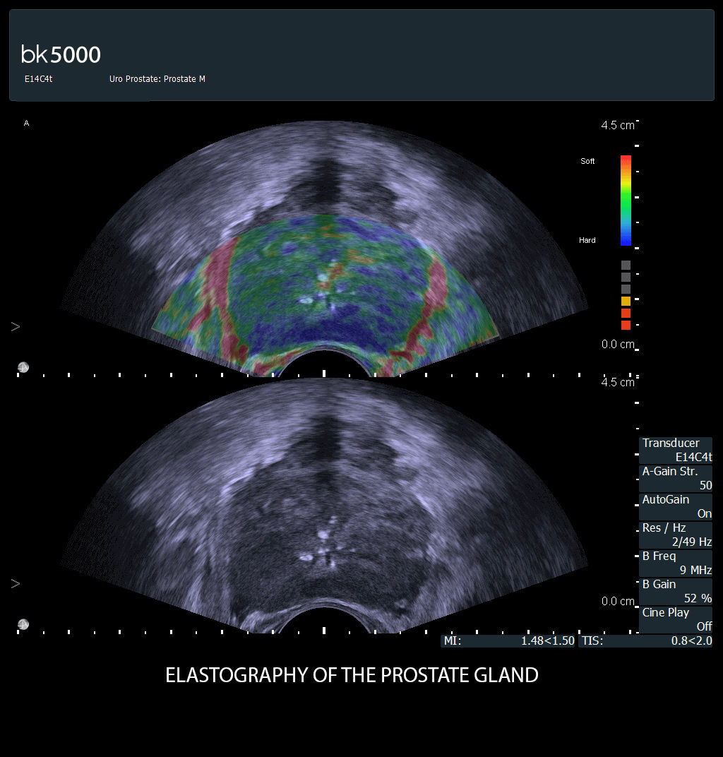 E14C4t Prostate cancer Elasto_7-