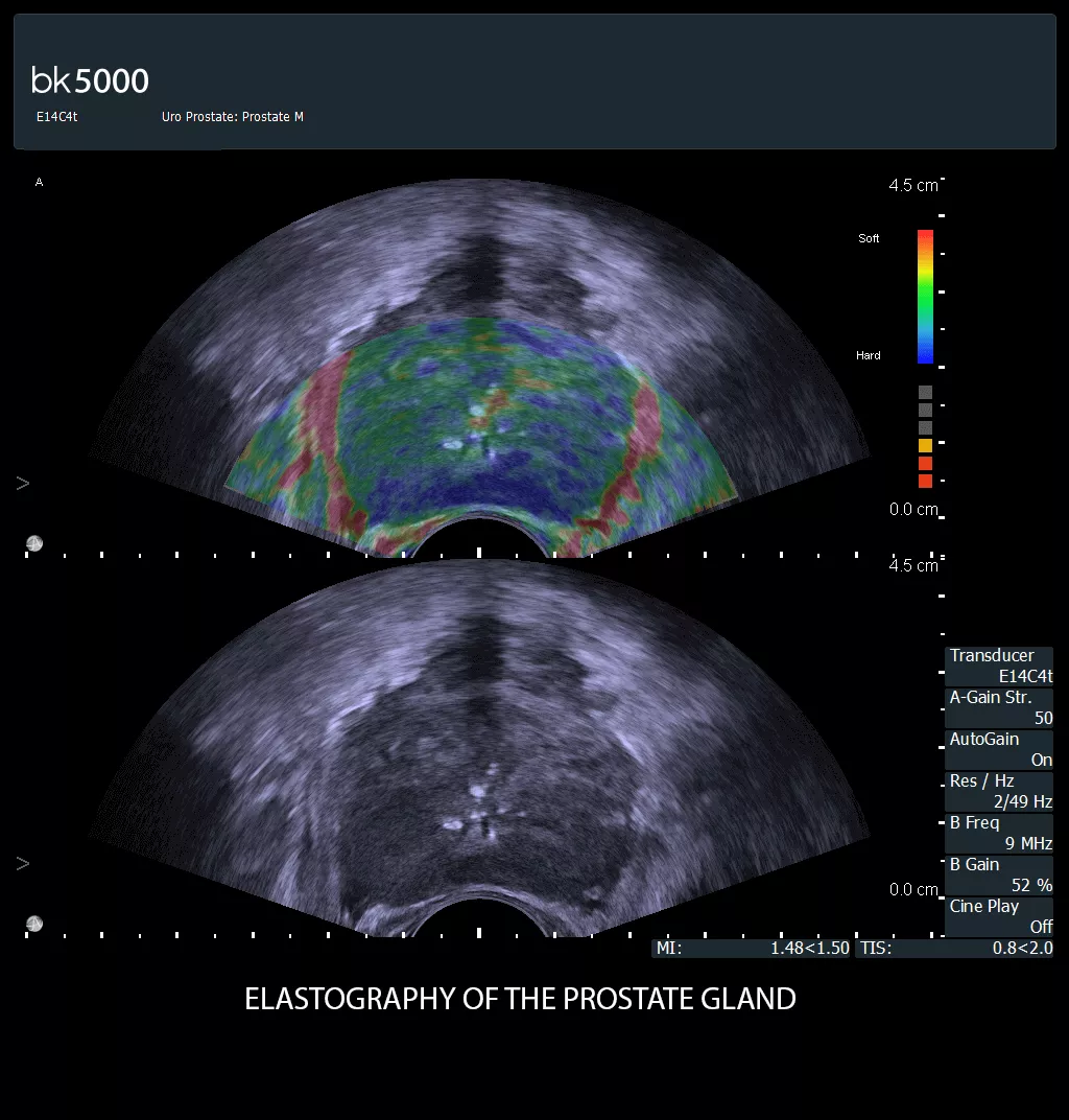 E14C4t Prostate cancer Elasto_7-