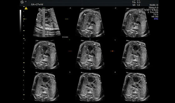 Voluson e6 SonoVCADheart