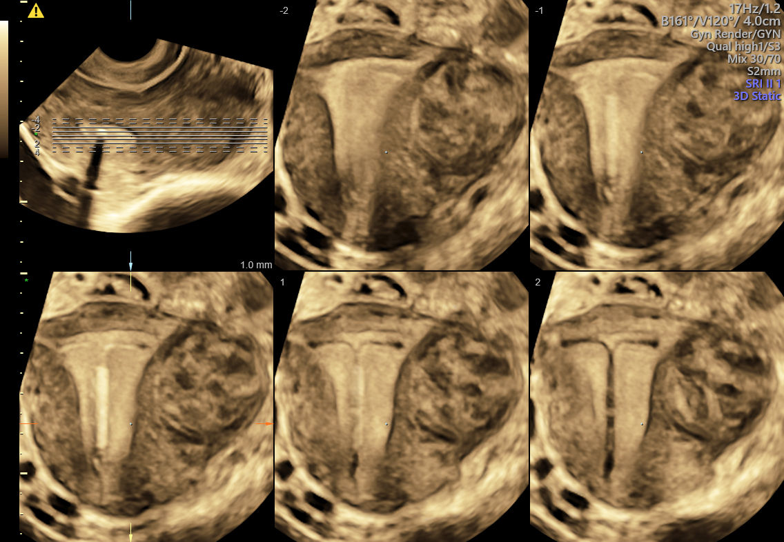 E6 Gallery coronal uterus