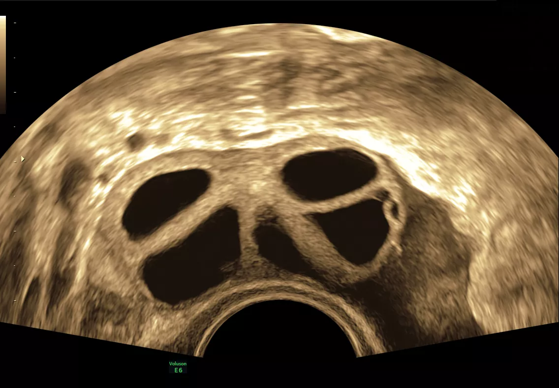 E6 Gallery Stimulated ovarian follicles
