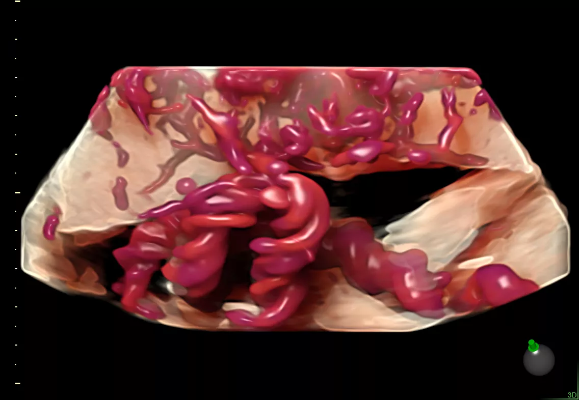 E6 Gallery umbilical cord