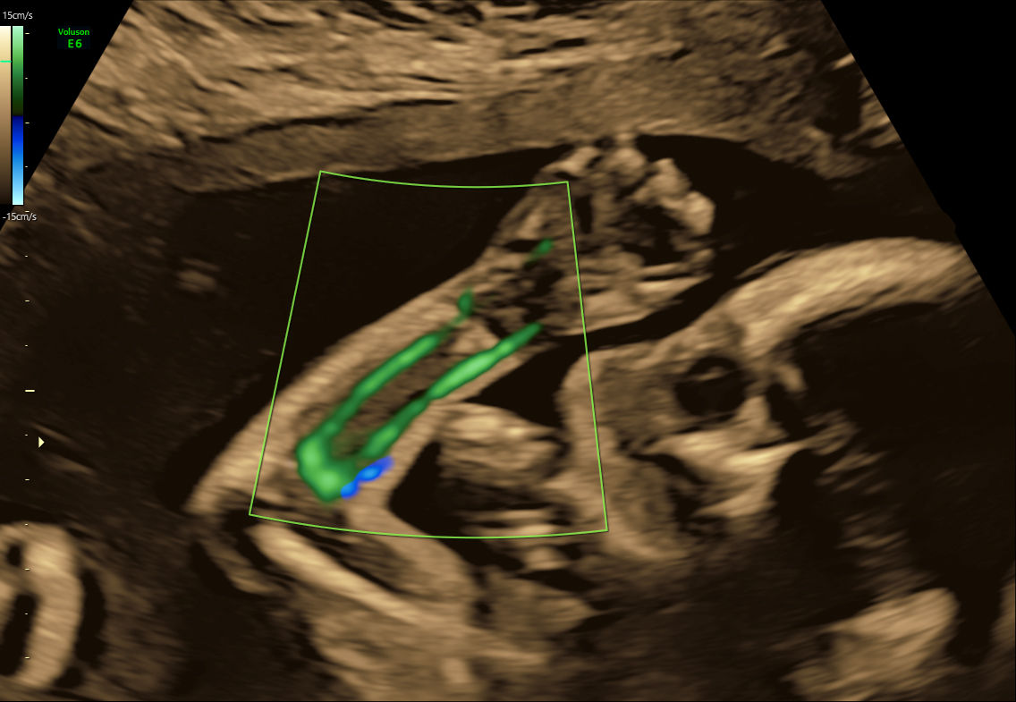 E6 Gallery HDflow fetal arm