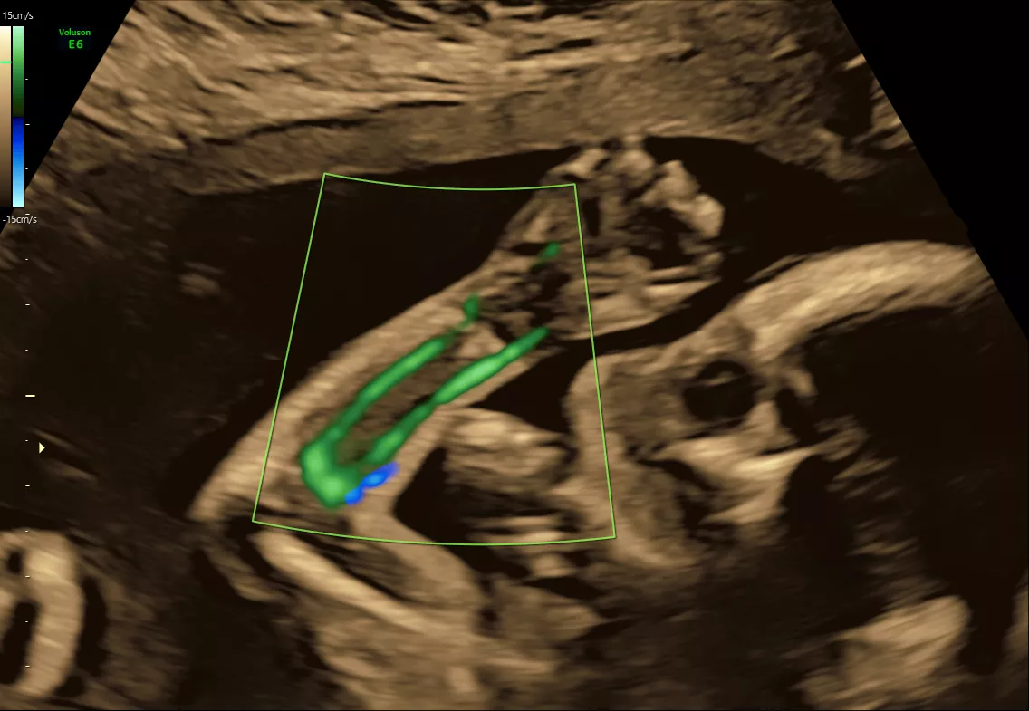 E6 Gallery HDflow fetal arm