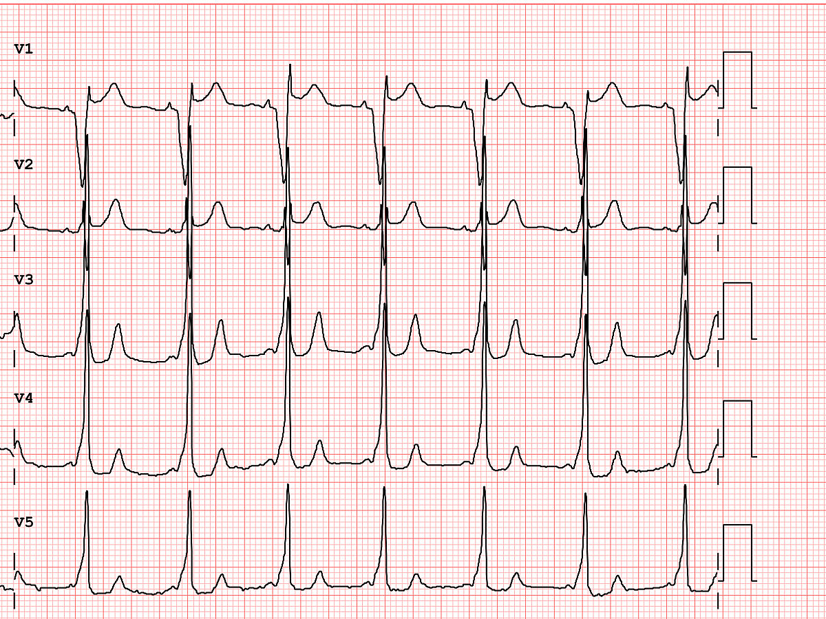 ecg-example-of-a-patholo