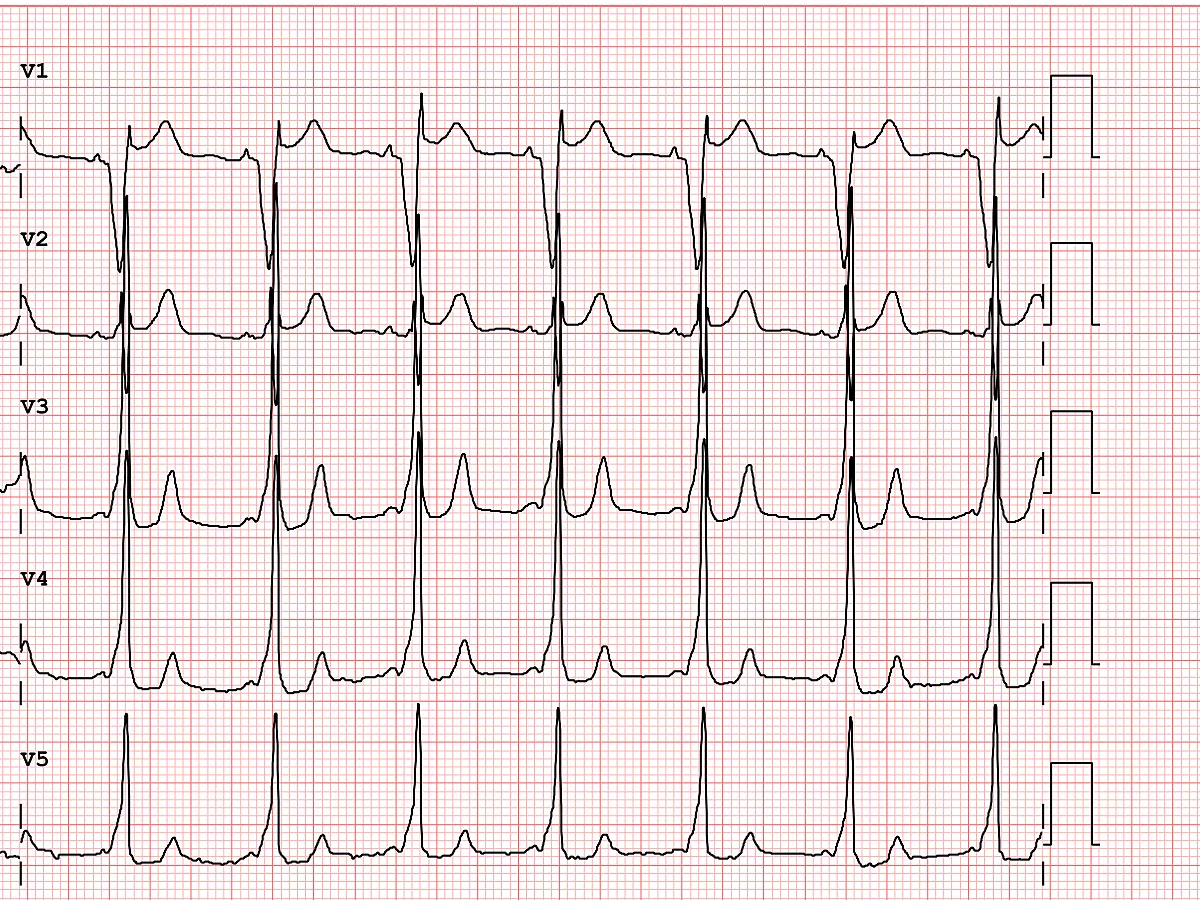 ecg-example-of-a-patholo