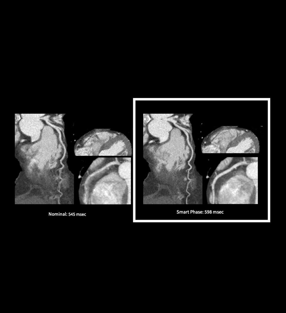 ecg-less-cardiac-ct-3-ci-en