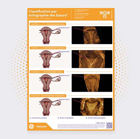 Echographie des Essure