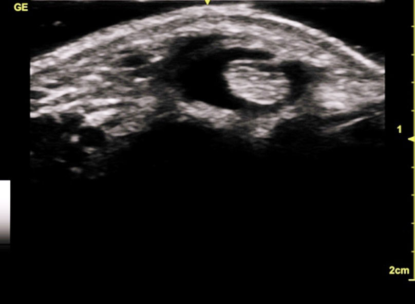 Flexor Carpi Ulnar Tendon with fluid due to trauma imaged using L12n-SC