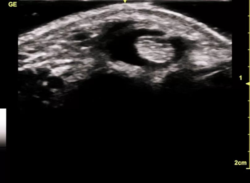 Flexor Carpi Ulnar Tendon with fluid due to trauma imaged using L12n-SC