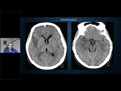 Emergency Neuroimaging Beyond Stroke and Bleed