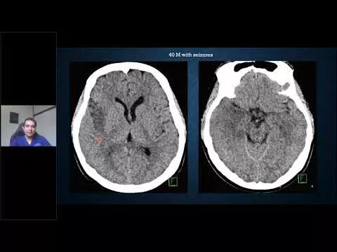 Emergency Neuroimaging Beyond Stroke and Bleed