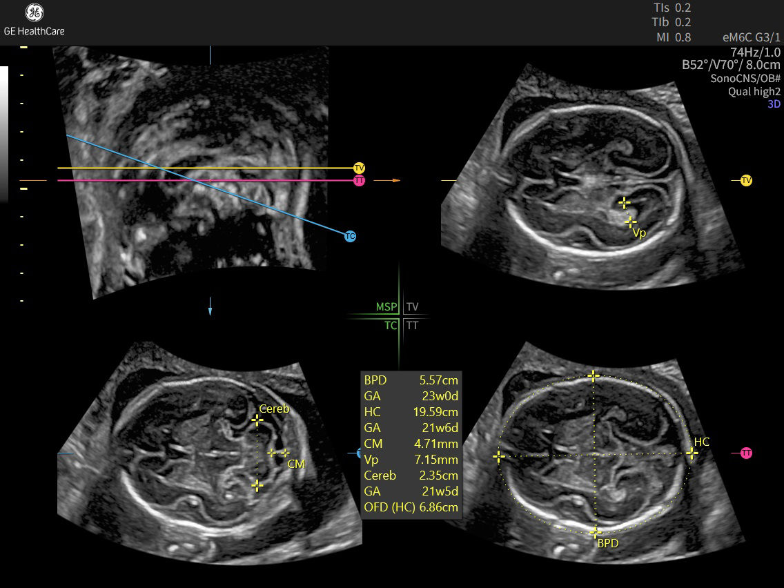 EXP22  EM6CG3 OB 3D SONOCNS RAD 23Wx