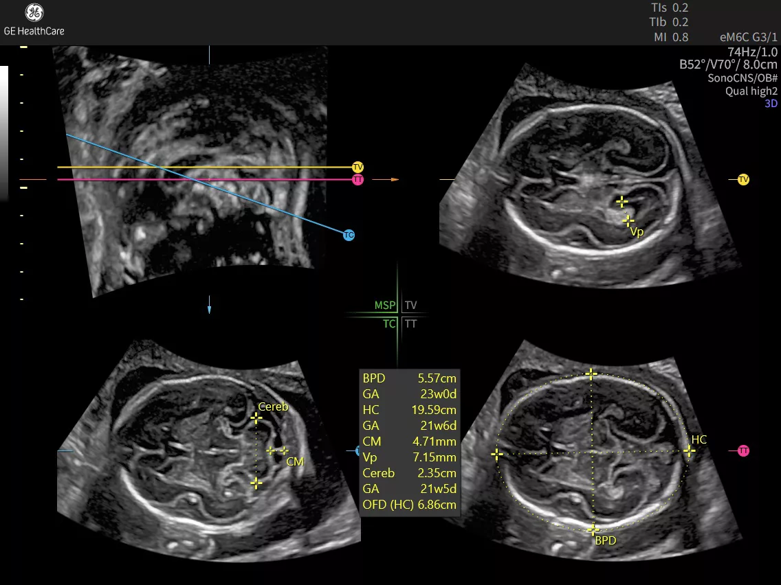 EXP22  EM6CG3 OB 3D SONOCNS RAD 23Wx