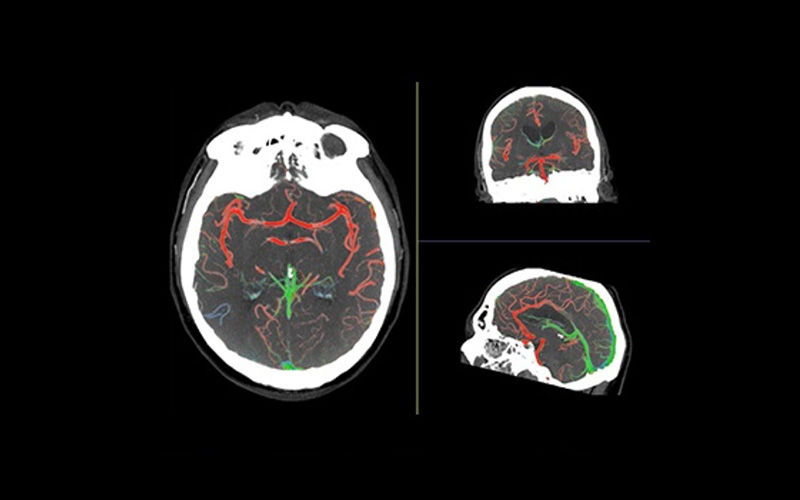 FastStroke-CT-Application