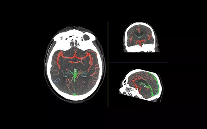 FastStroke-CT-Application