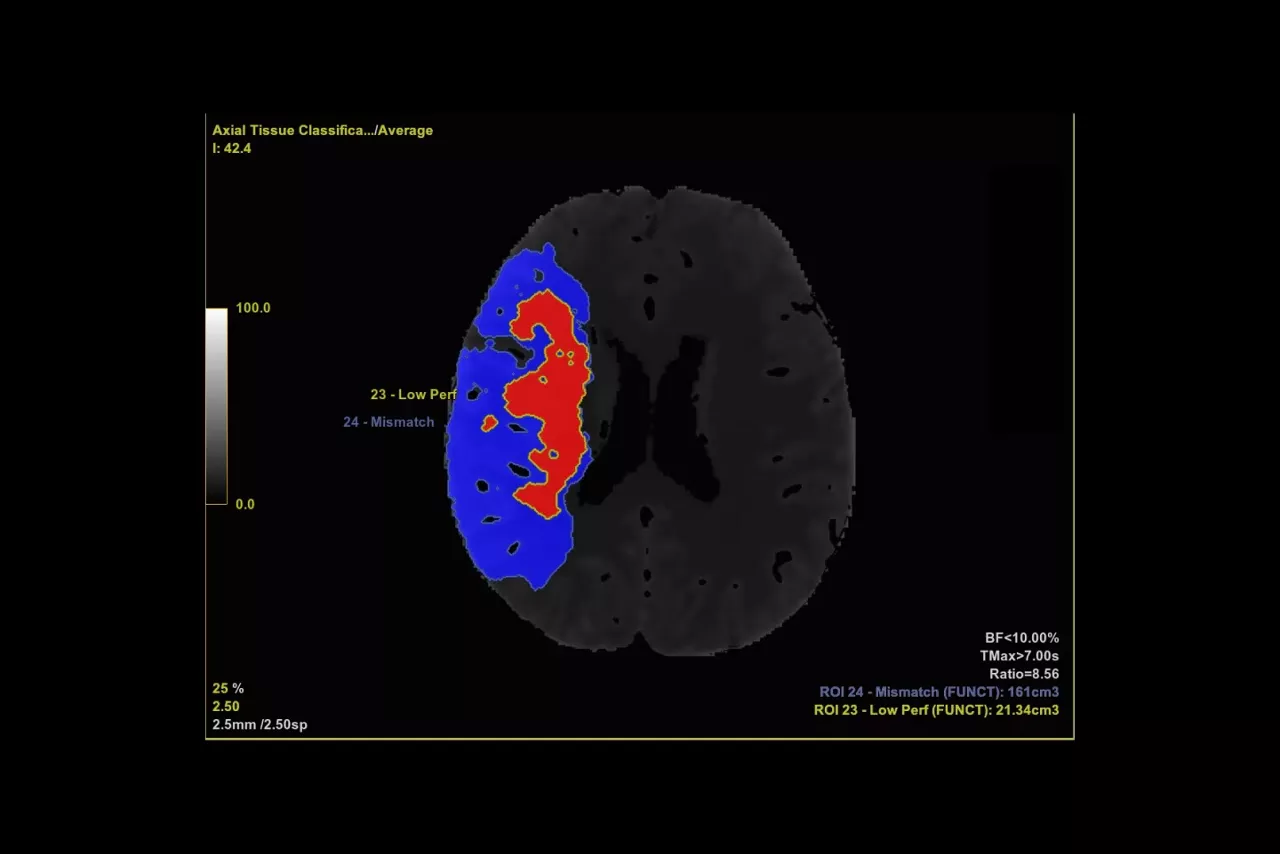 faststroke-perfusion-maps-ci-en
