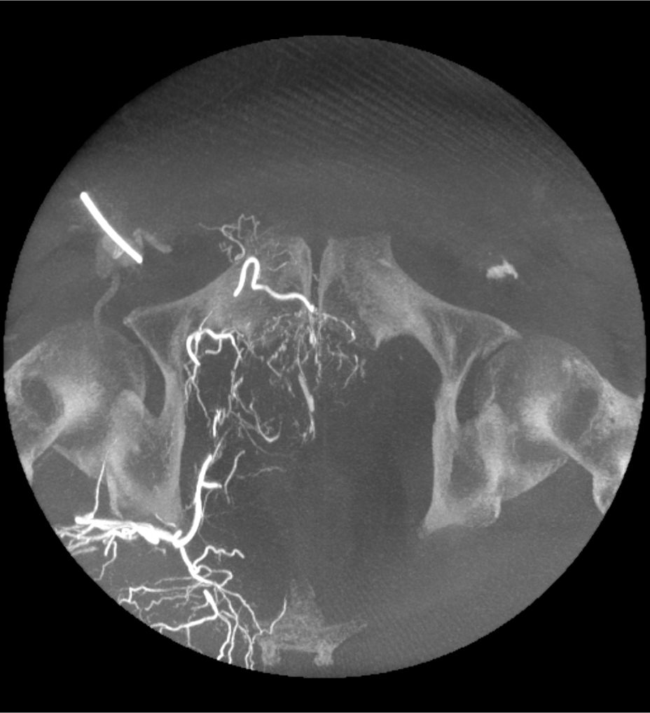 3D CT HD5: Enhanced soft-tissue visualization and noise reduction for high-quality CBCT imaging