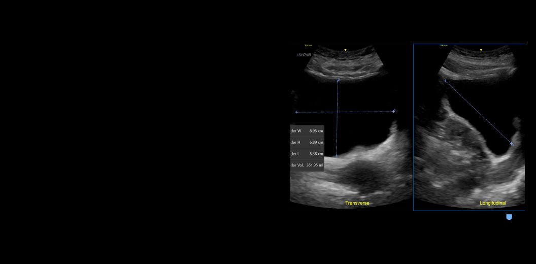 feature-card-full-width-bladder-volume-desktop