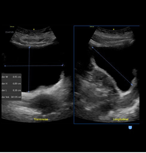 feature-card-full-width-bladder-volume-desktop crooped 1