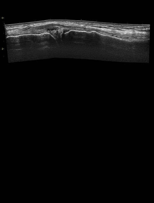 featurecard-Knee-joint-Meniscus-cyst-L4-20t-desktop
