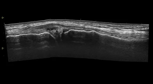 featurecard-Knee-joint-Meniscus-cyst-L4-20t-desktop