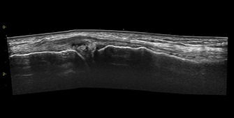 featurecard-knee-joint-meniscus-cyst-l4-20t-mobile1