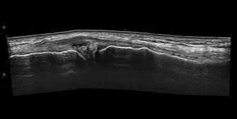 featurecard-knee-joint-meniscus-cyst-l4-20t-mobile1