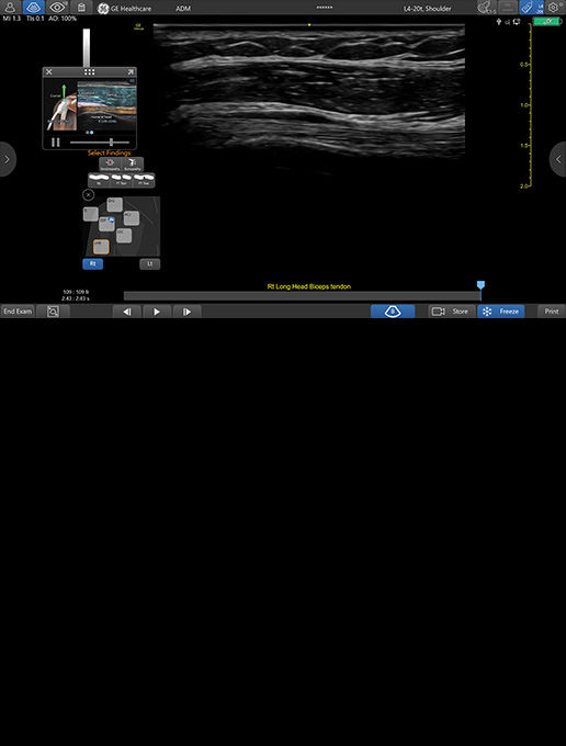 featurecard-L4-20t-RS-RIGHT-biceps-tendon-desktop
