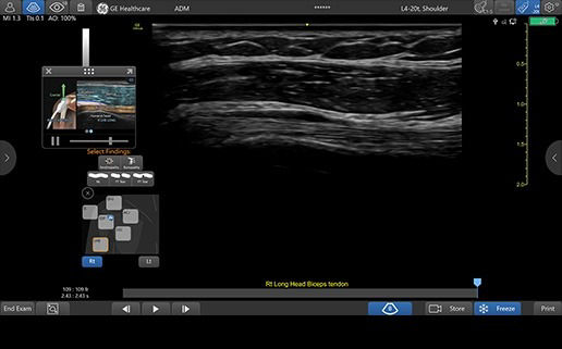 featurecard-l4-20t-rs-right-biceps-tendon-desktop1