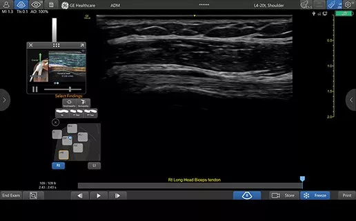 featurecard-l4-20t-rs-right-biceps-tendon-desktop1