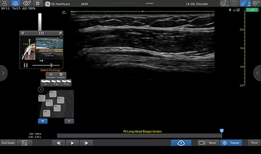 featurecard-L4-20t-RS-RIGHT-biceps-tendon-desktop