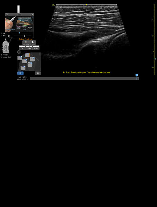featurecard-L4-20t-RS RIGHT-post-labrum-GHJ-desktop