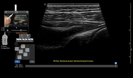 featurecard-l4-20t-rs-right-post-labrum-ghj-desktop1