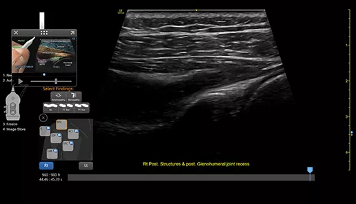 featurecard-L4-20t-RS RIGHT-post-labrum-GHJ-desktop