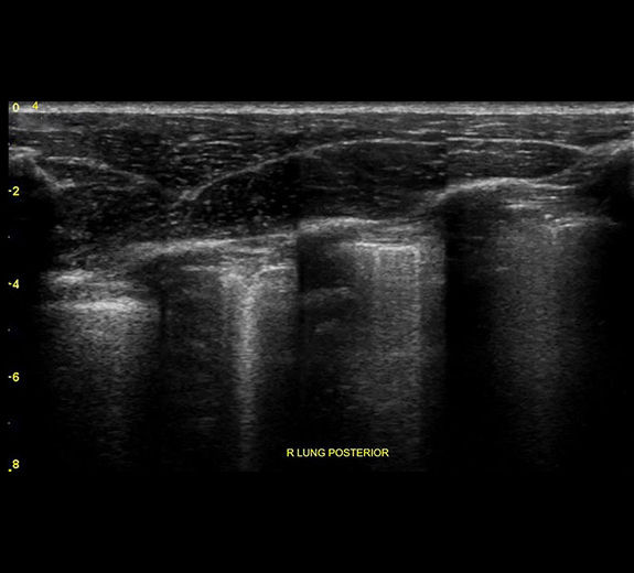 featurecard-lung-sweep-desktop