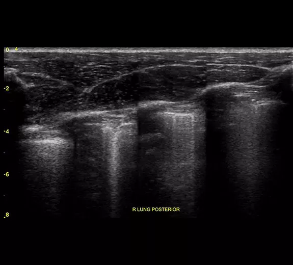 featurecard-lung-sweep-desktop