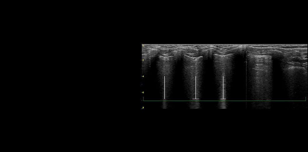featurecards-lung-sweep-desktop