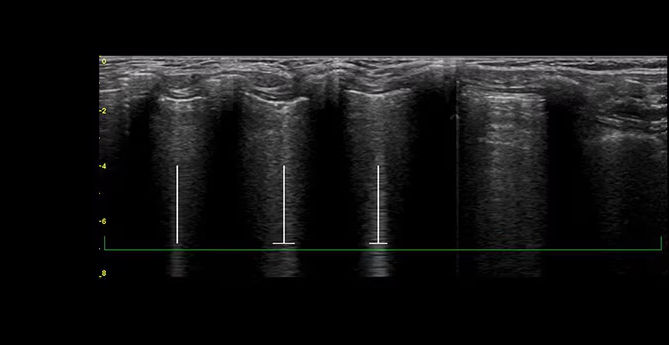featurecards-lung-sweep-desktop