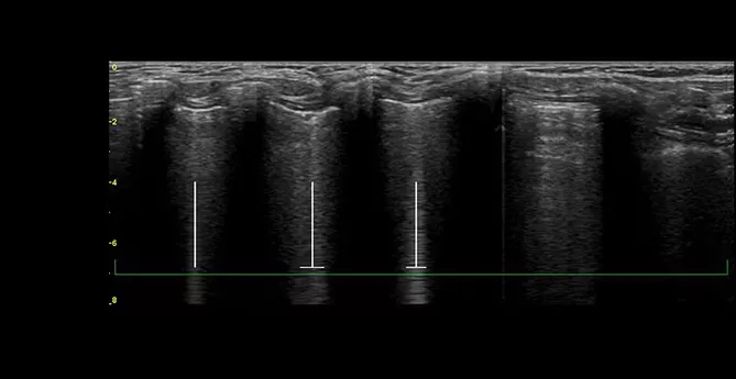 featurecards-lung-sweep-desktop