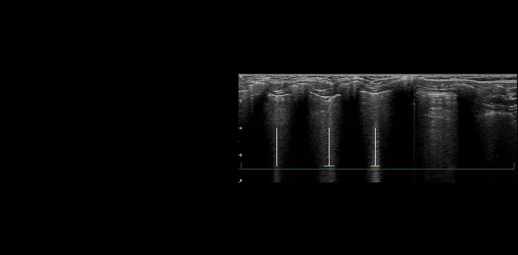 featurecards-lung-sweep-desktop